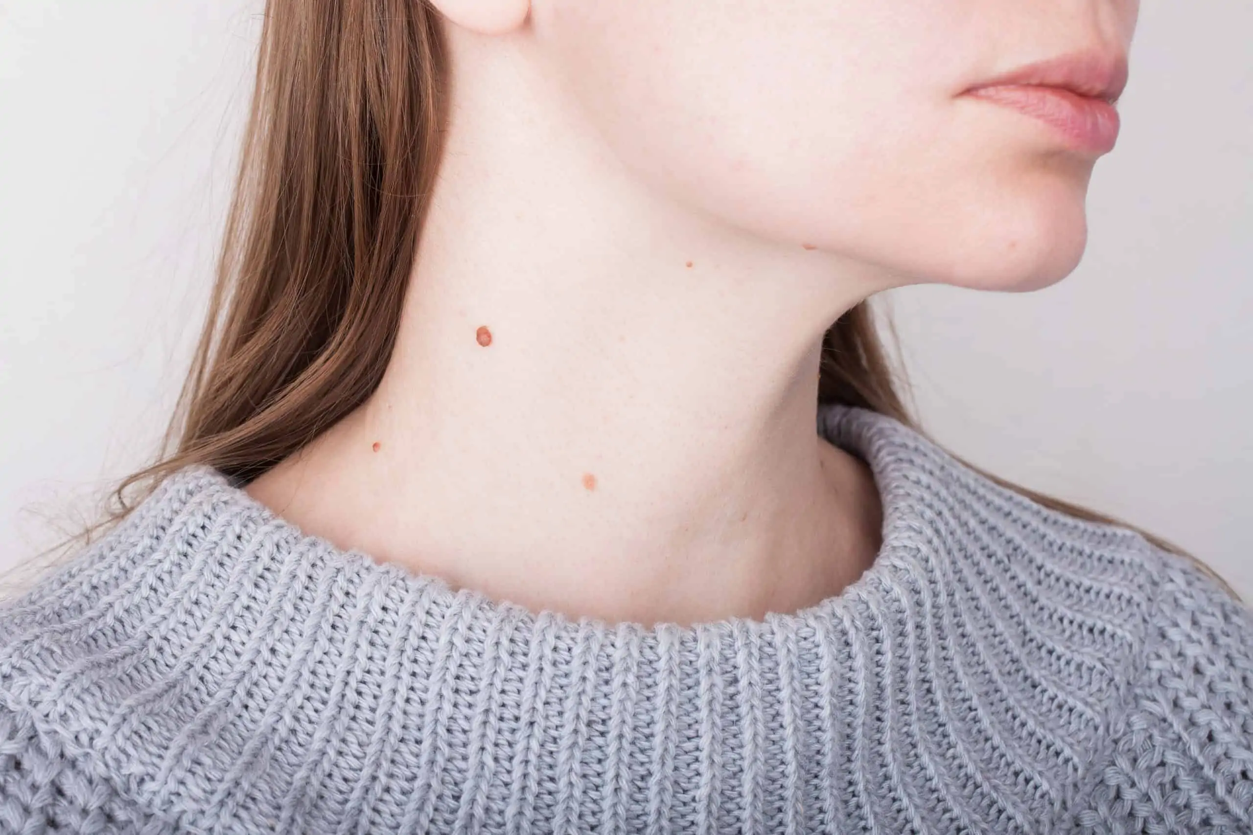 Bradavice na vratu – kako ih ukloniti