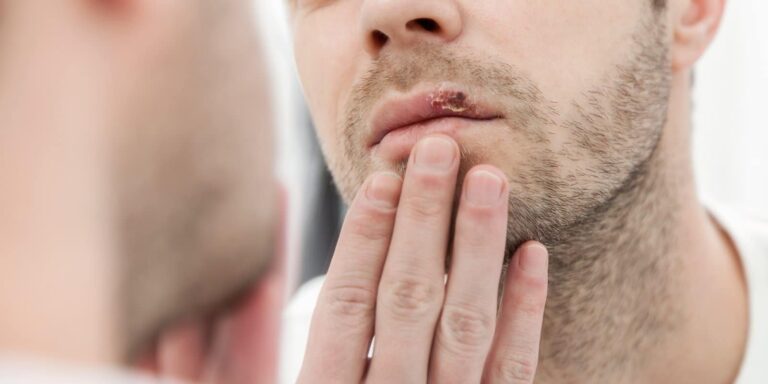 Zašto se herpes vraća
