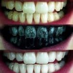 Izbeljivanje-zuba-aktivnim-ugljem